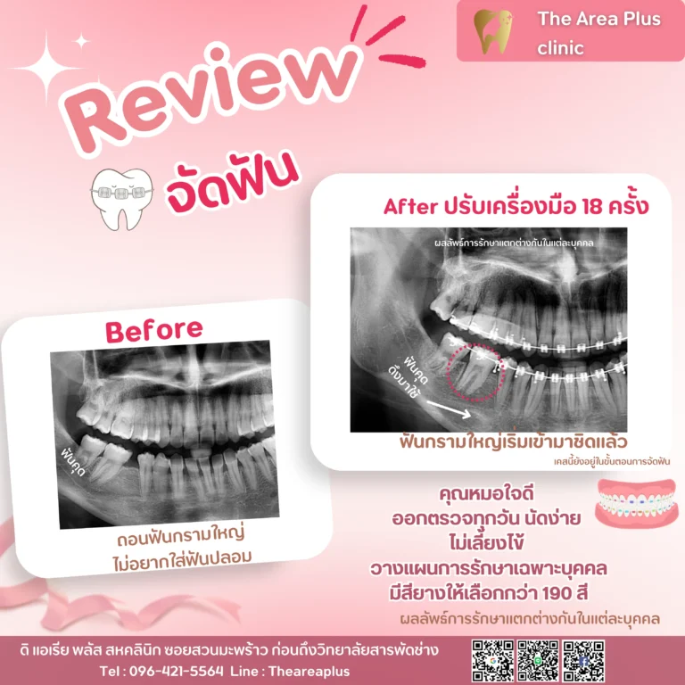 คลินิกทันตกรรมเฉพาะทางโคราช รีวิวจัดฟัน ฟันกรามใหญ่