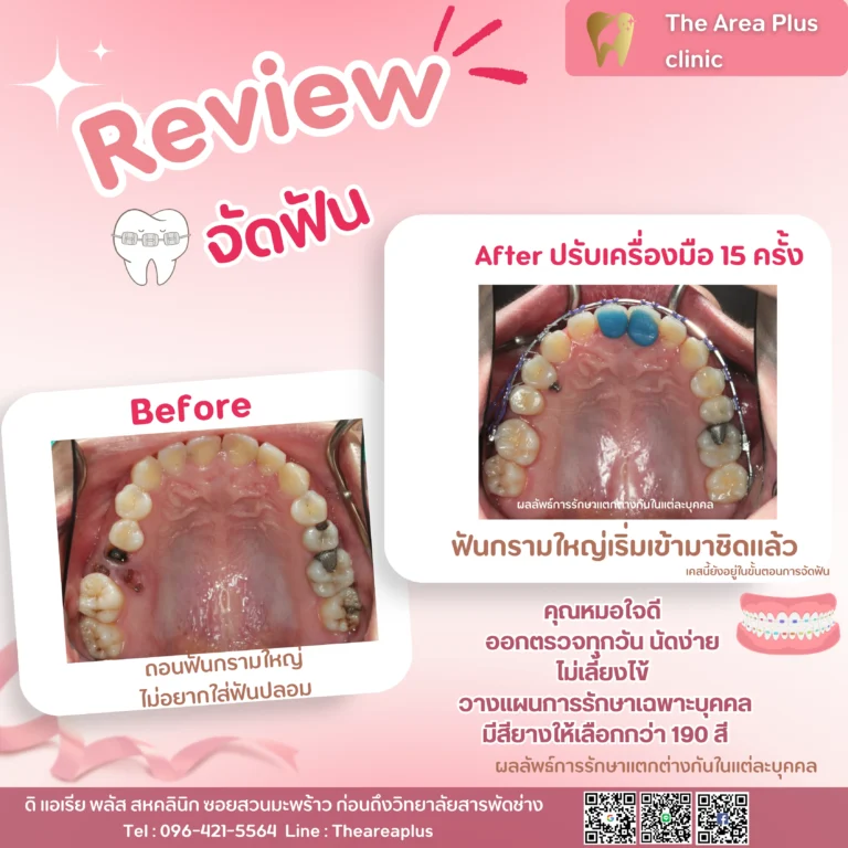 คลินิกทันตกรรมเฉพาะทางโคราช รีวิวจัดฟัน ฟันกรามใหญ่