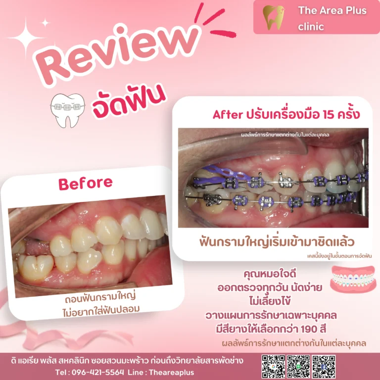 คลินิกทันตกรรมเฉพาะทางโคราช รีวิวจัดฟัน ฟันกรามใหญ่