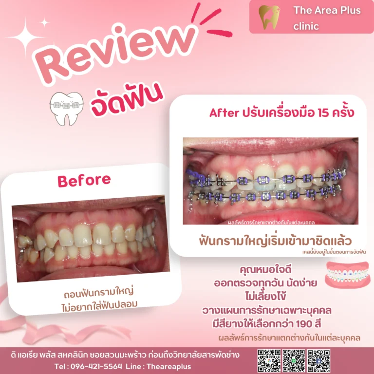 คลินิกทันตกรรมเฉพาะทางโคราช รีวิวจัดฟัน ฟันกรามใหญ่