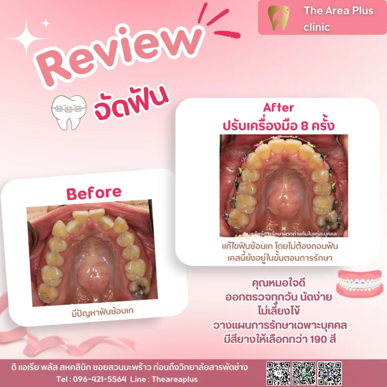 คลินิกทันตกรรมเฉพาะทางโคราช รีวิวจัดฟัน แก้ไขฟันซ้อนเก โดยไม่ต้องถอนฟัน