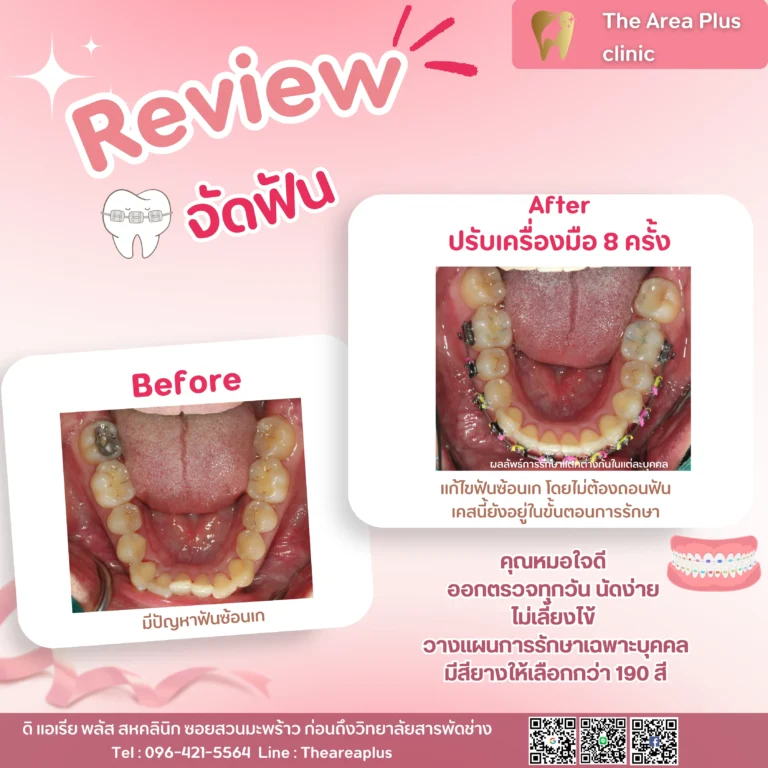 คลินิกทันตกรรมเฉพาะทางโคราช รีวิวจัดฟัน แก้ไขฟันซ้อนเก โดยไม่ต้องถอนฟัน