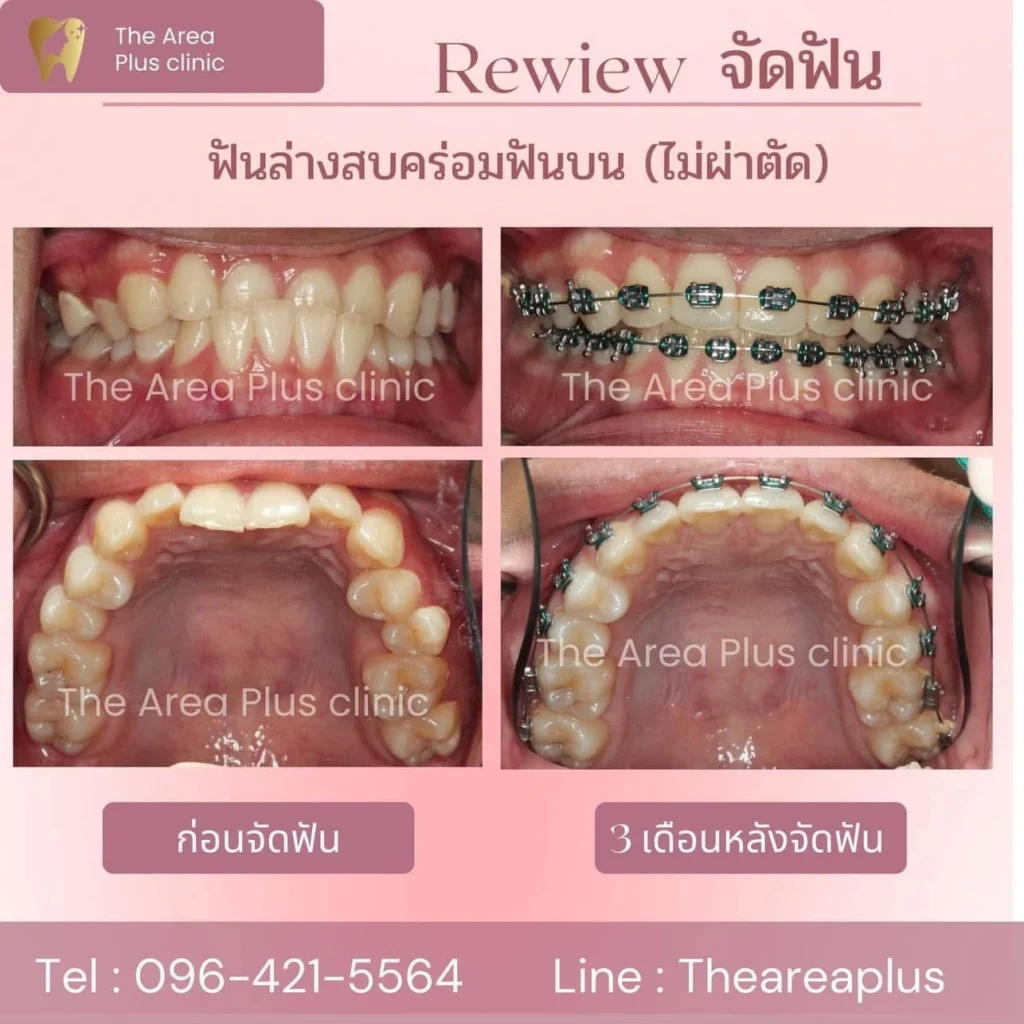จัดฟันแบบโลหะ IMG_3898