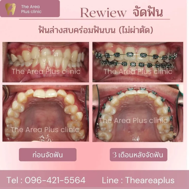 คลินิกทันตกรรมเฉพาะทางโคราช รีวิวจัดฟัน ฟันล่างสบคร่อมฟันบน (ไม่ผ่าตัด)