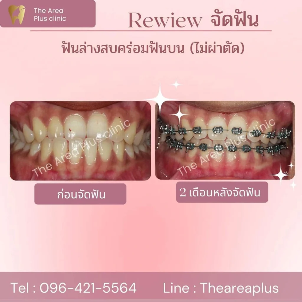 จัดฟันแบบโลหะ IMG_3899