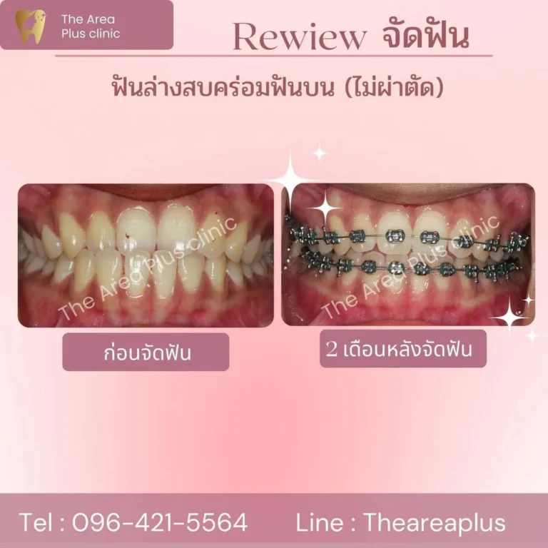 คลินิกทันตกรรมเฉพาะทางโคราช รีวิวจัดฟัน ฟันล่างสบคร่อมฟันบน (ไม่ผ่าตัด)