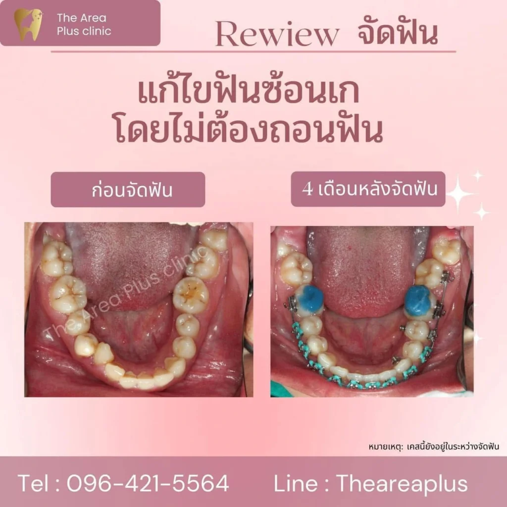 จัดฟันแบบโลหะ IMG_3901