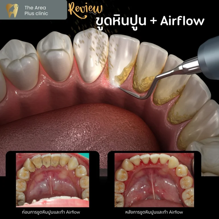 คลินิกทันตกรรมเฉพาะทางโคราช ขูดหินปูน + Air flow
