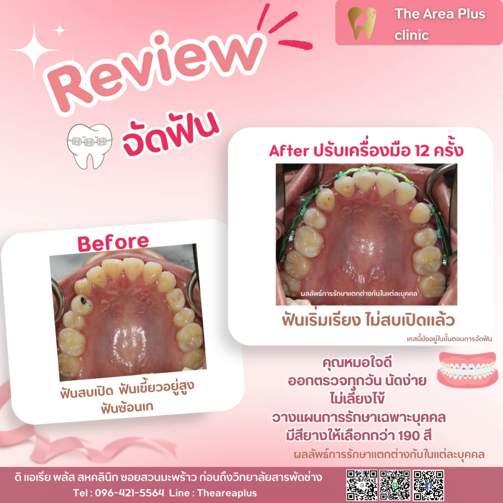 จัดฟันแบบโลหะ สำเนาของ-สำเนาของ-รีวิว-before-after.zip-45