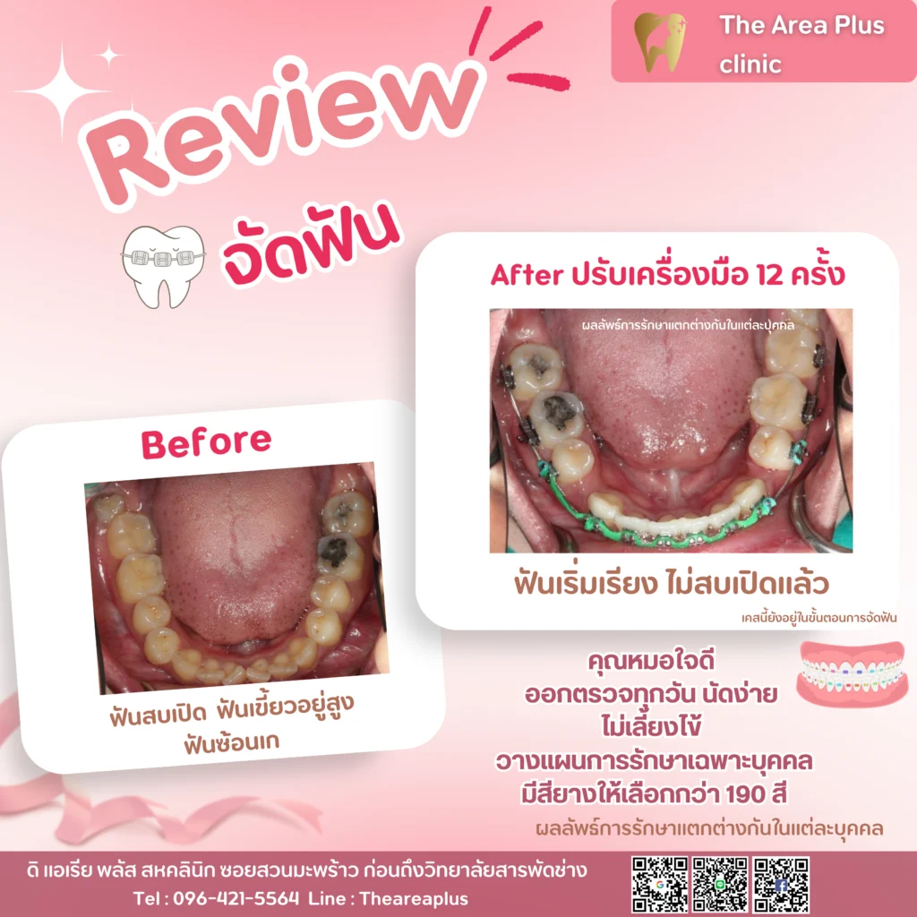 จัดฟันแบบโลหะ สำเนาของ-สำเนาของ-รีวิว-before-after.zip-46