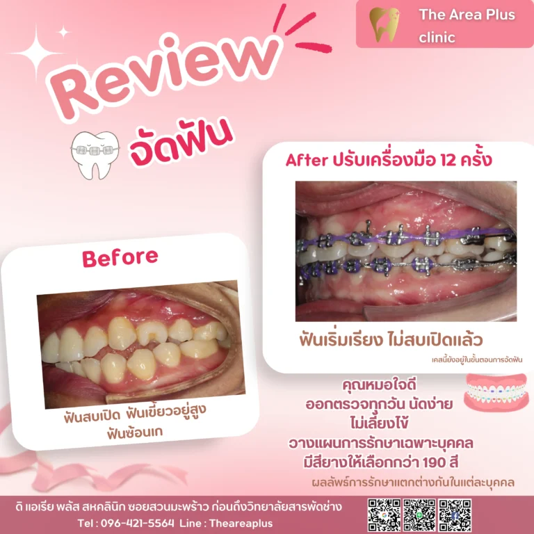 คลินิกทันตกรรมเฉพาะทางโคราช รีวิวจัดฟัน