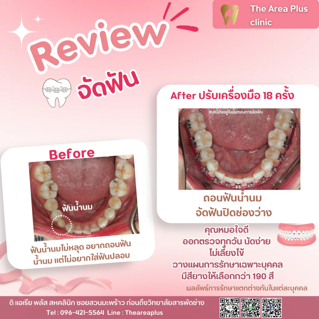 จัดฟันแบบโลหะ สำเนาของ-สำเนาของ-รีวิว-before-after.zip-50