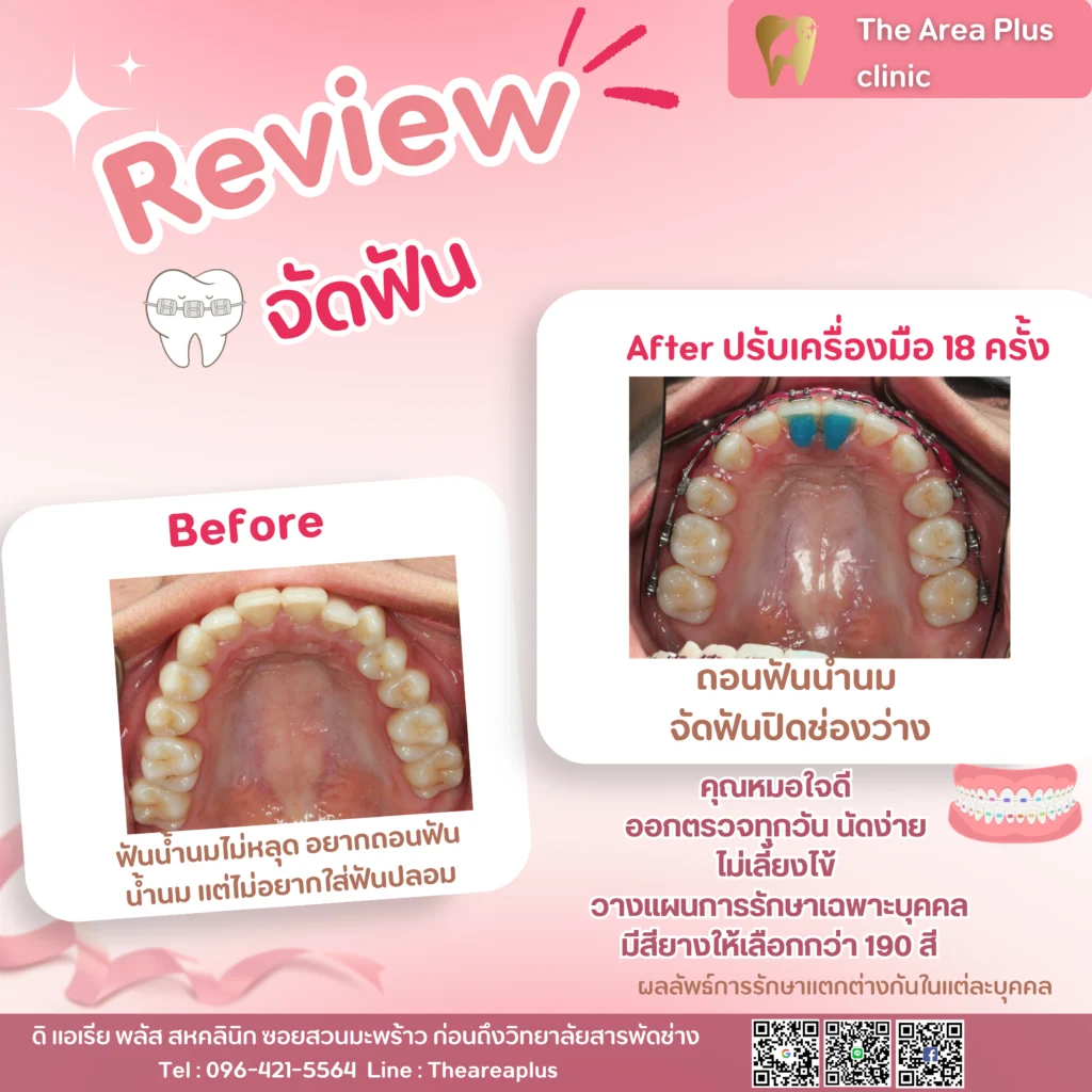 จัดฟันแบบโลหะ สำเนาของ-สำเนาของ-รีวิว-before-after.zip-53