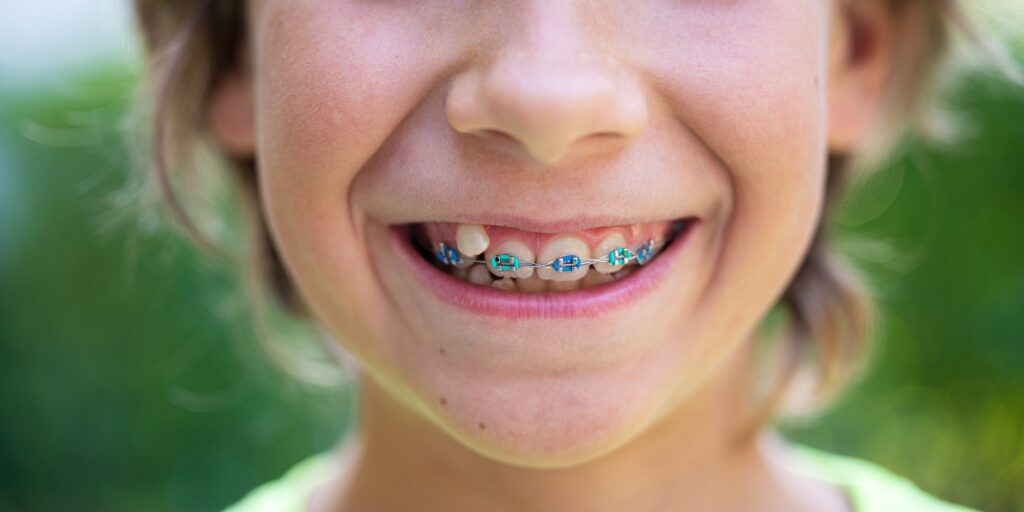 จัดฟันเด็ก: คู่มือสำหรับคุณพ่อคุณแม่ Child with dental braces