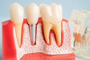 บริการรากฟันเทียมโคราช โดยทันตแพทย์เฉพาะทาง Dental implant, artificial tooth roots into jaw, root canal of dental treatment, gum disease, teeth
