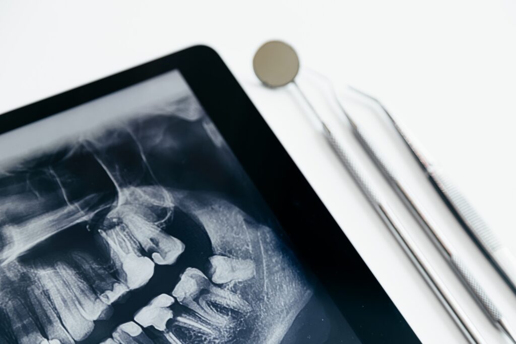 ฟันคุดขึ้นไม่เต็มที่ต้องถอนไหม Dental instruments and jaw x-ray on white table. Panoramic digital jaw x-ray on tablet