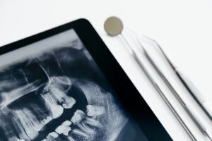 ผ่าฟันคุด Dental instruments and jaw x-ray on white table. Panoramic digital jaw x-ray on tablet