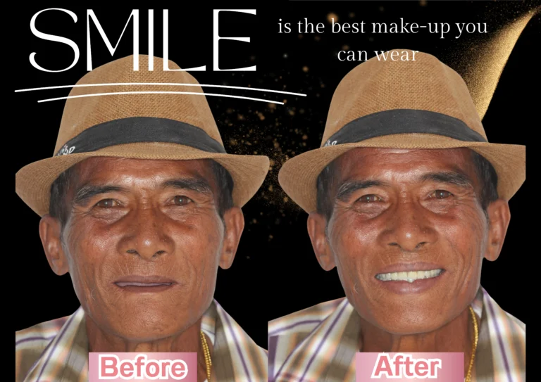 คลินิกทันตกรรมเฉพาะทางโคราช รีวิว ฟันปลอม The Area Plus Clinic