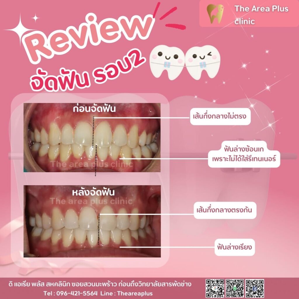 จัดฟันแบบโลหะ 3deaa5e7-a9d2-4abf-8e96-0f2d15f57d72