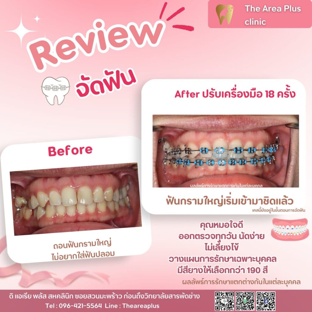 จัดฟันแบบโลหะ รีวิวจัดฟัน ฟันกรามใหญ่