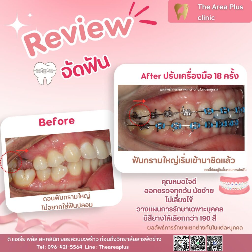 จัดฟันแบบโลหะ รีวิวจัดฟัน the area plus clinic