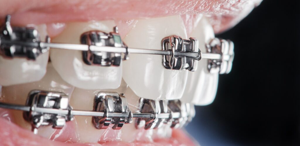 จัดฟันโลหะ (Metal Braces)