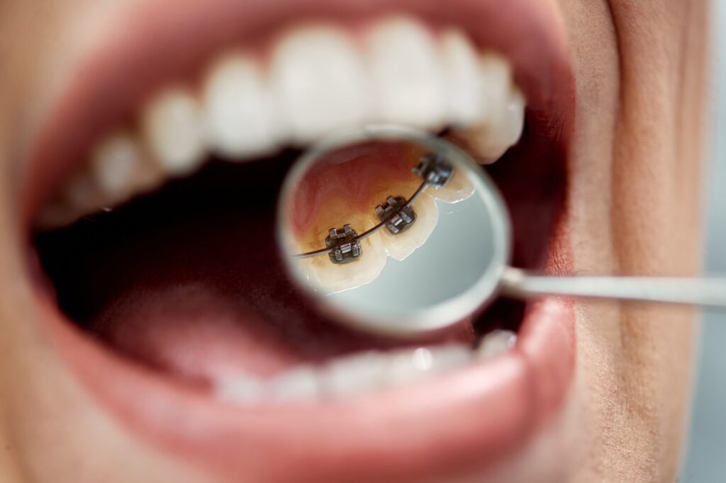 จัดฟันด้านใน (Lingual Braces)
