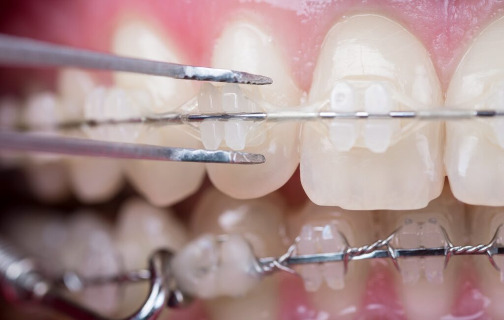 จัดฟันเซรามิก (Ceramic Braces)
