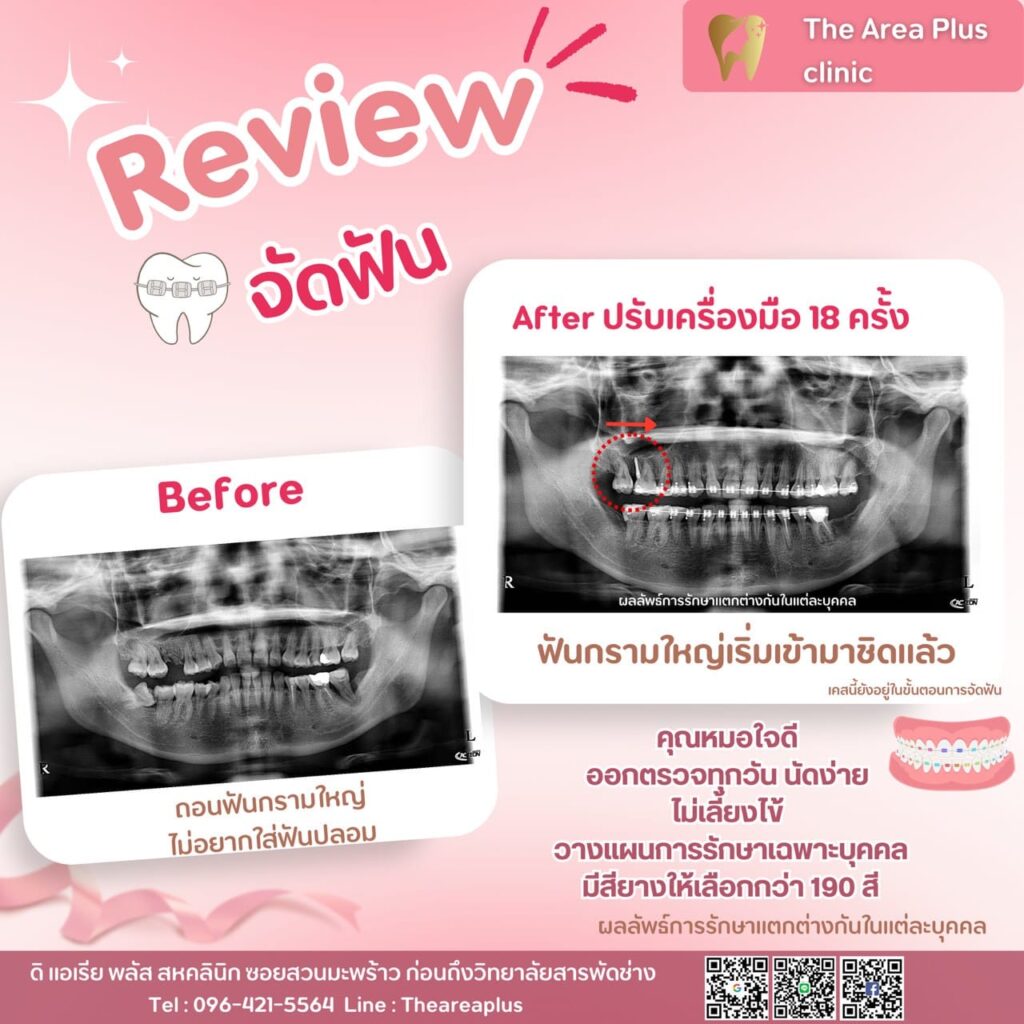 จัดฟันแบบโลหะ รีวิวจัดฟัน the area plus clinic