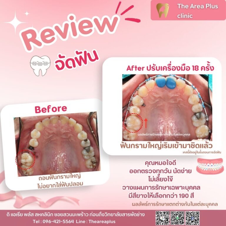คลินิกทันตกรรมเฉพาะทางโคราช รีวิวจัดฟัน the area plus clinic