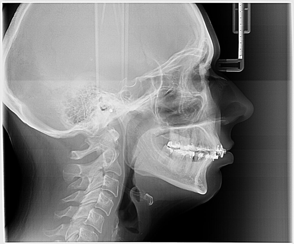 Head profile x-ray teeth with braces for orthodontic purpose
